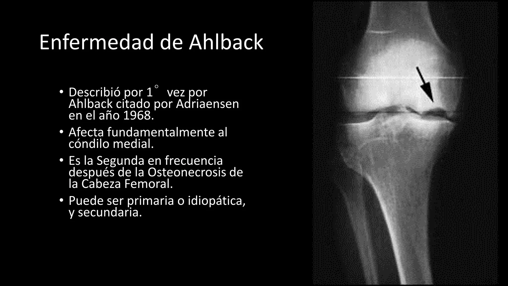 Enfermedad de Ahlback | PPT