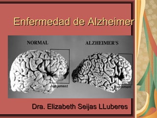Enfermedad de AlzheimerEnfermedad de Alzheimer
Dra. Elizabeth Seijas LLuberesDra. Elizabeth Seijas LLuberes
 