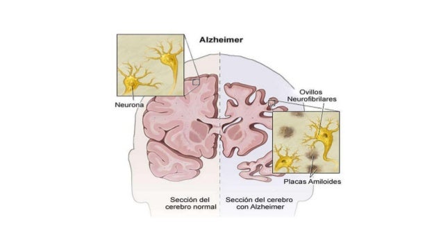 Enfermedad de Alzheimer Enfermedad de Alzheimer