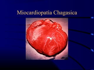 Miocardiopatía Chagasica
 
