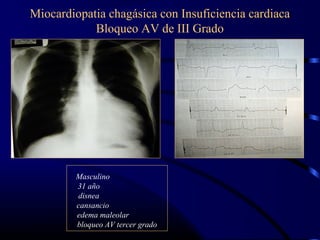 Miocardiopatia chagásica con Insuficiencia cardiaca
Bloqueo AV de III Grado
Masculino
31 año
disnea
cansancio
edema maleolar
bloqueo AV tercer grado
 