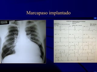 Marcapaso implantado
 
