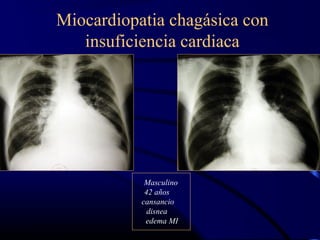 Miocardiopatia chagásica con
insuficiencia cardiaca
Masculino
42 años
cansancio
disnea
edema MI
 