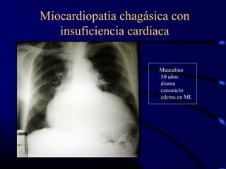 Miocardiopatia chagásica con
insuficiencia cardiaca
Masculino
50 años
disnea
cansancio
edema en MI.
 