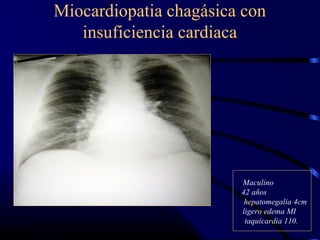 Miocardiopatia chagásica con
insuficiencia cardiaca
Maculino
42 años
hepatomegalia 4cm
ligero edema MI
taquicardia 110.
 