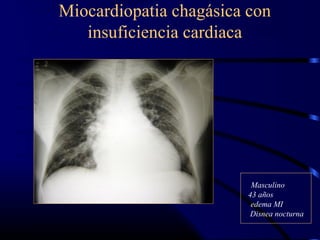 Miocardiopatia chagásica con
insuficiencia cardiaca
Masculino
43 años
edema MI
Disnea nocturna
 