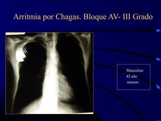 Arritmia por Chagas. Bloque AV- III Grado
Masculino
42 año
mareos
 