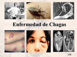 Enfermedad de ChagasEnfermedad de Chagas
DR
 