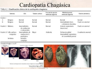 Cardiopatía Chagásica
 