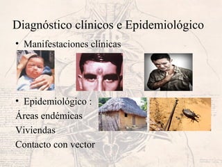Diagnóstico clínicos e Epidemiológico
• Manifestaciones clínicas
• Epidemiológico :
Áreas endémicas
Viviendas
Contacto con vector
 