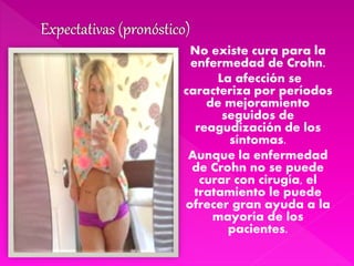 No existe cura para la
enfermedad de Crohn.
La afección se
caracteriza por períodos
de mejoramiento
seguidos de
reagudización de los
síntomas.
Aunque la enfermedad
de Crohn no se puede
curar con cirugía, el
tratamiento le puede
ofrecer gran ayuda a la
mayoría de los
pacientes.
 