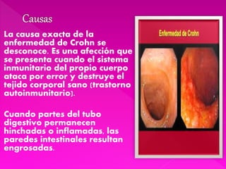 La causa exacta de la
enfermedad de Crohn se
desconoce. Es una afección que
se presenta cuando el sistema
inmunitario del propio cuerpo
ataca por error y destruye el
tejido corporal sano (trastorno
autoinmunitario).
Cuando partes del tubo
digestivo permanecen
hinchadas o inflamadas, las
paredes intestinales resultan
engrosadas.
 