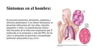 Síntomas en el hombre:
Se presenta neumonía, bronquitis, empiema y
abscesos pulmonares. Con menor frecuencia, se
presentan infecciones de vías altas: sinusitis,
epiglotitis y otitis. La manifestación clínica
más frecuente de la infección respiratoria por P.
multocida es la neumonía y más del 90% de los
casos se presentan en pacientes con patología
pulmonar subyacente.(López,2016)
https://res.cloudinary.com/middlesex-hospital/image/upload/mhsMayoMedia/671275b4-a4e6-4a86-8f06-
eb8b18b002fa_es
 