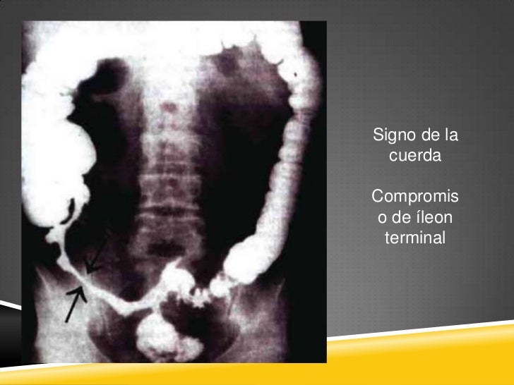 Enfermedad de crohn