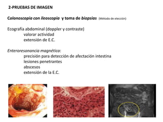2-PRUEBAS DE IMAGEN

Colonoscopia con ileoscopia y toma de biopsias   (Método de elección)


Ecografía abdominal (doppler y contraste)
         valorar actividad
         extensión de E.C.

Enteroresonancia magnética:
        precisión para detección de afectación intestina
        lesiones penetrantes
        abscesos
        extensión de la E.C.
 