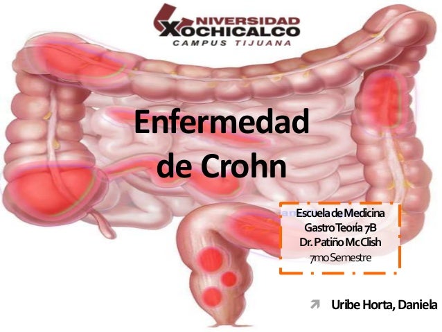 Crohn's disease - Wikipedia
