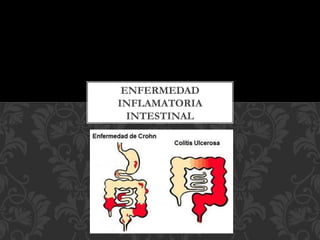 ENFERMEDAD
INFLAMATORIA
INTESTINAL
 
