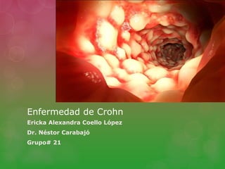 Enfermedad de Crohn
Ericka Alexandra Coello López
Dr. Néstor Carabajó
Grupo# 21
 