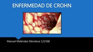 ENFERMEDAD DE CROHN
Manuel Meléndez Mendoza 121568
 