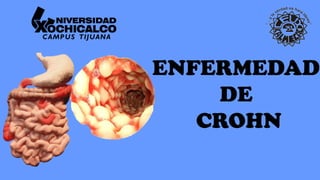 ENFERMEDAD
DE
CROHN
 