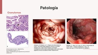Patología
Granulomas
Infosalus, & Infosalus. (s. f.). Signos de enfermedad de
Crohn, una enfermedad digestiva crónica e incurable.
infosalus.com. https://www.infosalus.com/salud-
investigacion/noticia-signos-enfermedad-crohn-enfermedad-
digestiva-cronica-incurable-20190611082435.html
Enfermedad de Crohn : MedlinePlus
Enciclopedia médica. (s. f.).
https://medlineplus.gov/spanish/ency/article/0
00249.htm
Marteau, P., Allez, M., & Jian, R. (2013). Enfermedad de
Crohn. EMC - Tratado de Medicina, 17(4), 1-8.
https://doi.org/10.1016/s1636-5410(13)65895-x
 