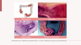 “Skip Lesions” Estenosis
Microscópico Patrón en empedrado
Enfermedad de Crohn : MedlinePlus Enciclopedia médica. (s. f.). https://medlineplus.gov/spanish/ency/article/000249.htm
 