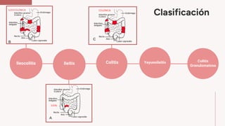 Clasificación
Ileocolitis Ileítis Colitis Yeyunoileitis Colitis
Granulomatosa
 