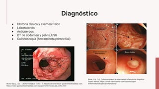 Diagnóstico
● HIstoria clínica y examen físico
● Laboratorios
● Anticuerpos
● CT de abdomen y pelvis, USG
● Colonoscopía (herramienta primordial)
Murra-Saca, J. (s. f.). Enfermedad de Crohn - El Atlas Gastrointestinal - gastrointestinalatlas.com.
https://www.gastrointestinalatlas.com/espanol/enfermedad_de_crohn.html
Rivas, I. (s. f.-a). Colonoscopia en la enfermedad inflamatoria idiopática.
Gastro Mérida. https://www.ivanrivasmd.com/colonoscopia-
enfermedad-idiopatica-inflamatoria/
 