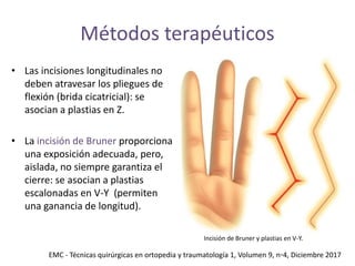 Brunner Incision Han Enfermedad de Dupuytren.pptx
