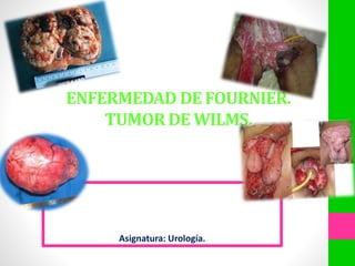 ENFERMEDAD DE FOURNIER.
TUMOR DE WILMS.
Asignatura: Urología.
 