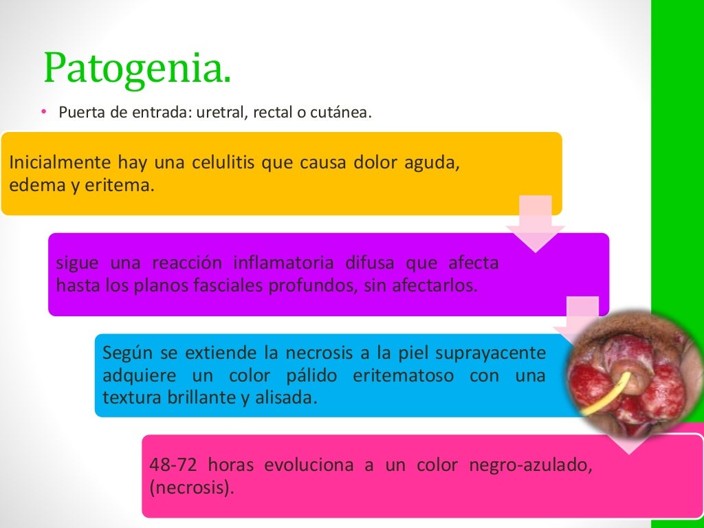 Enfermedad de fournier