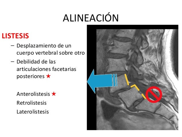 Enfermedad degenerativa en columna lumbar Enfermedad degenerativa en columna lumbar