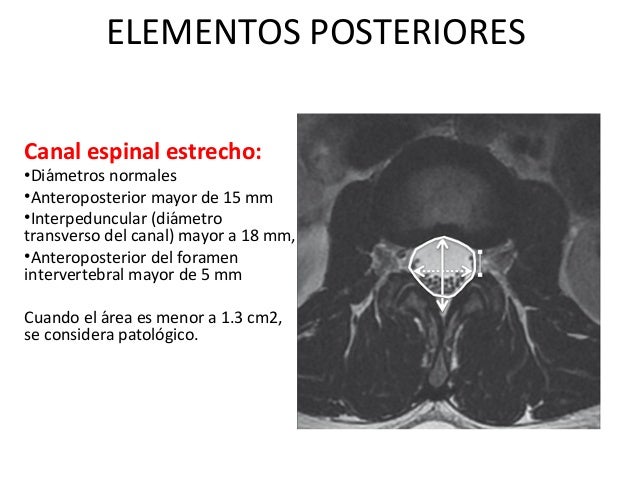 Enfermedad degenerativa en columna lumbar Enfermedad degenerativa en columna lumbar
