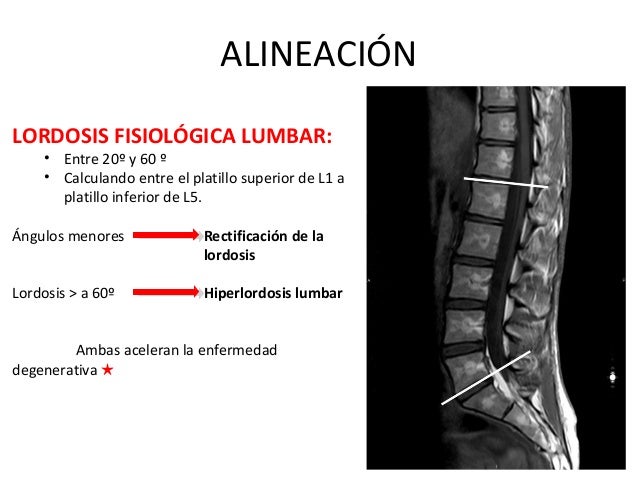 Enfermedad degenerativa en columna lumbar
