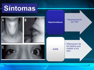 Síntomas
• Hipersecreción
de TSHHipertiroidismo
• Inflamación de
los tejidos que
rodean a los
ojos
OJOS
 