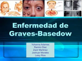 Enfermedad de
Graves-Basedow
Yohanna Adames
Ramiro Diaz
Zazir Martinez
Joshuar Morales
Leisy Rios
 