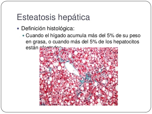 ESTEATOSIS HEPATICA DEFINICION PDF ESTEATOSIS HEPATICA DEFINICION PDF
