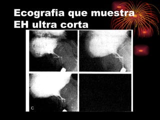 Ecografia que muestra
EH ultra corta
 