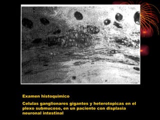 Examen histoquimico
Celulas ganglionares gigantes y heterotopicas en el
plexo submucoso, en un paciente con displasia
neuronal intestinal
 