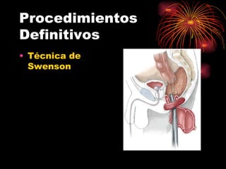Procedimientos
Definitivos
• Técnica de
  Swenson
 