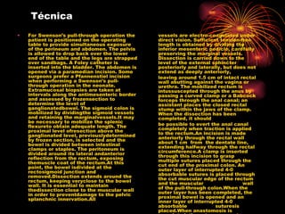Técnica
•   For Swenson’s pull-through operation the     vessels are electro-coagulated under
    patient is positioned on the operating       direct vision. Sufficient tension-free
    table to provide simultaneous exposure       length is obtained by dividing the
    of the perineum and abdomen. The pelvis      inferior mesenteric pedicle, carefully
    is allowed to drop back over the lower       preserving the marginal vessels.
    end of the table and the legs are strapped   Dissection is carried down to the
    over sandbags. A Foley catheter is           level of the external sphincter
    inserted into the bladder. The abdomen is    posteriorly and laterally, but does not
    opened via a paramedian incision. Some       extend as deeply anteriorly,
    surgeons prefer a Pfannenstiel incision      leaving around 1.5 cm of intact rectal
    when performing a Swenson’s pull-            wall abutting against the vagina or
    through operation in the neonate.            urethra. The mobilized rectum is
    Extramucosal biopsies are taken at           intussuscepted through the anus by
    intervals along the antimesenteric border    passing a curved clamp or a Babcock
    and assessed by frozensection to             forceps through the anal canal; an
    determine the level of                       assistant places the closed rectal
    ganglionatedbowel. The sigmoid colon is      stump within the jaws of the clamp.
    mobilized by dividingthe sigmoid vessels     When the dissection has been
    and retaining the marginalvessels.It may     completed, it should
    be necessary to mobilize the splenic
    flexureto obtain adequate length. The        be possible to evert the anal canal
    proximal level ofresection above the         completely when traction is applied
    ganglionated level, previouslydetermined     to the rectum.An incision is made
    by frozen section, is selected and the       anteriorly through the rectal wall
    bowel is divided between intestinal          about 1 cm from the dentate line,
    clamps or staples. The peritoneum is         extending halfway through the rectal
    divided around its lateral andanterior       circumference.A clamp is inserted
    reflection from the rectum, exposing         through this incision to grasp
    themuscle coat of the rectum.At this         multiple sutures placed through the
    point, the bowel isdivided at the            cut end of the proximal colon. An
    rectosigmoid junction and                    outer layer of interrupted 4-0
    removed.Dissection extends around the        absorbable sutures is placed through
    rectum, keeping veryclose to the bowel       the cut muscular edge of the rectum
    wall. It is essential to maintain            and the muscular                   wall
    thedissection close to the muscular wall     of the pull-through colon.When the
    in order to preventdamage to the pelvic      outer layer has been completed, the
    splanchnic innervation.All                   proximal bowel is opened and an
                                                 inner layer of interrupted 4-0
                                                 absorbable              suturesis
                                                 placed.When anastomosis is
 