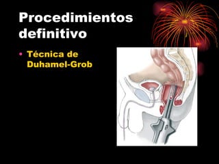 Procedimientos
definitivo
• Técnica de
  Duhamel-Grob
 