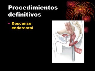 Procedimientos
definitivos
• Descenso
  endorectal
 
