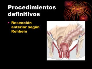 Procedimientos
definitivos
• Resección
  anterior según
  Rehbein
 