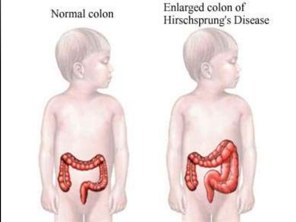 Enfermedad de hirschsprung sp
