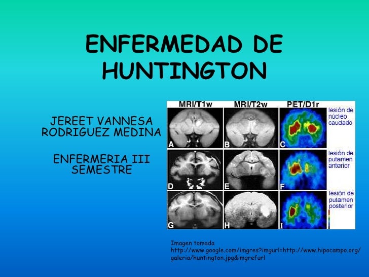 Enfermedad de huntington Enfermedad de huntington