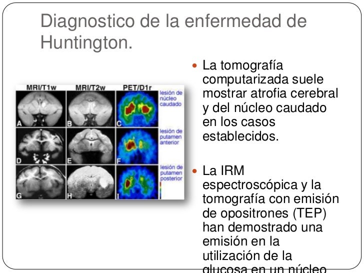Enfermedad de huntington Enfermedad de huntington