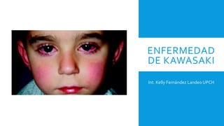 ENFERMEDAD
DE KAWASAKI
Int. Kelly Fernández Landeo UPCH
 
