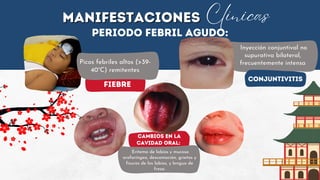 FIEBRE
Cambios en la
cavidad oral:
Eritema de labios y mucosa
orofaríngea, descamación, grietas y
fisuras de los labios, y lengua de
fresa.
MANIFESTACIONES
MANIFESTACIONES Clínicas
Periodo febril agudo:
Picos febriles altos (>39-
40°C) remitentes
Conjuntivitis
Inyección conjuntival no
supurativa bilateral,
frecuentemente intensa
 