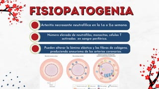 fisiopatogenia
fisiopatogenia
Arteritis necrosante neutrofílica en la 1.a o 2.a semana.
Número elevado de neutrófilos, monocitos, células T
activadas en sangre periférica.
Pueden alterar la lámina elástica y las fibras de colágeno,
produciendo aneurisma de las arterias coronarias.
 